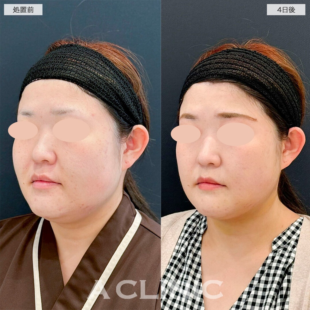 1day小顔脂肪吸引とバッカルファット除去術で4日後なのに腫れるどころか変化を実感！処置前と4日後の症例です(30代女性)