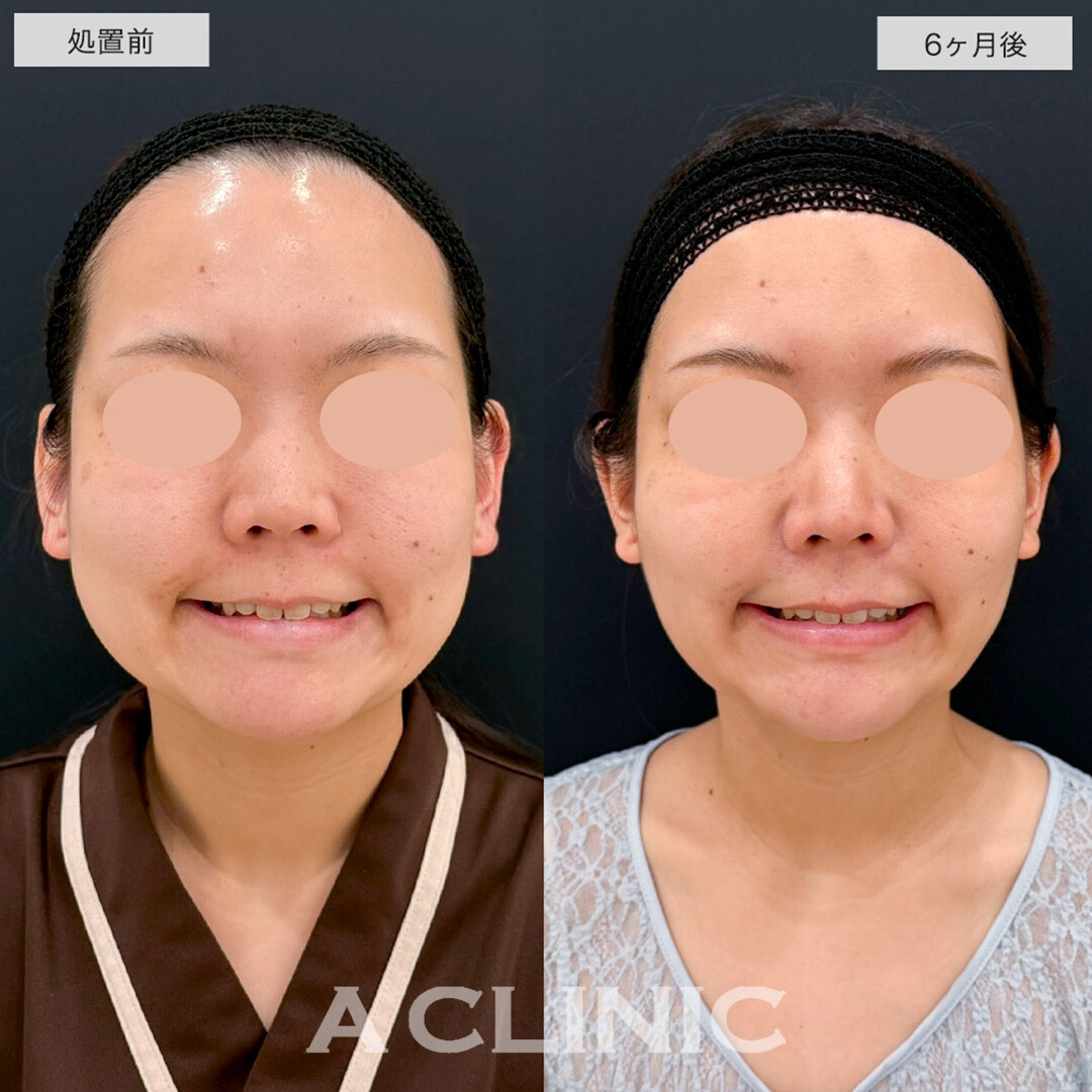 1day小顔脂肪吸引の半年後もスッキリした輪郭をキープし続けます!こちら処置前と6ヶ月後の症例です(20代女性)