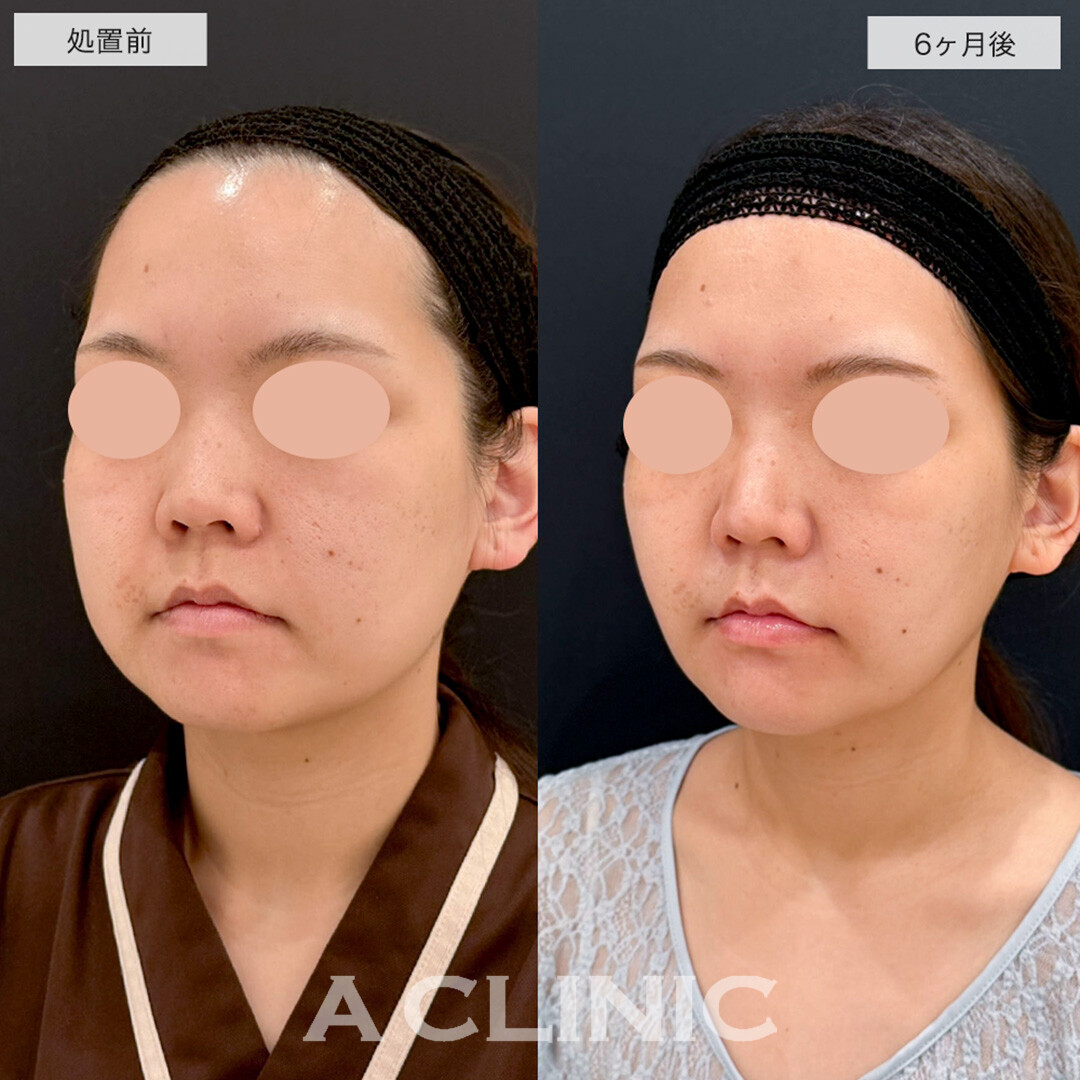 1day小顔脂肪吸引の半年後もスッキリした輪郭をキープし続けます!こちら処置前と6ヶ月後の症例です(20代女性)