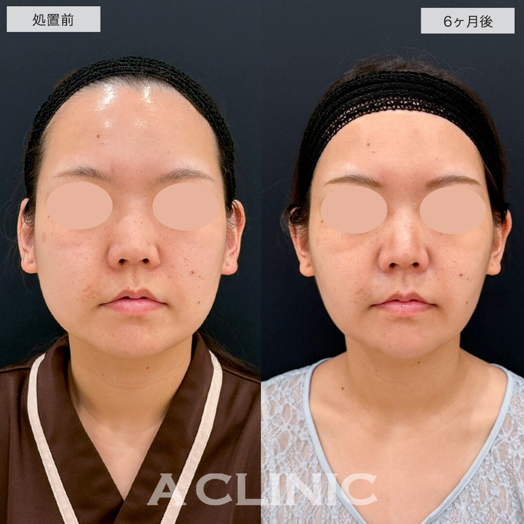 1day小顔脂肪吸引の半年後もスッキリした輪郭をキープし続けます!こちら処置前と6ヶ月後の症例です(20代女性)