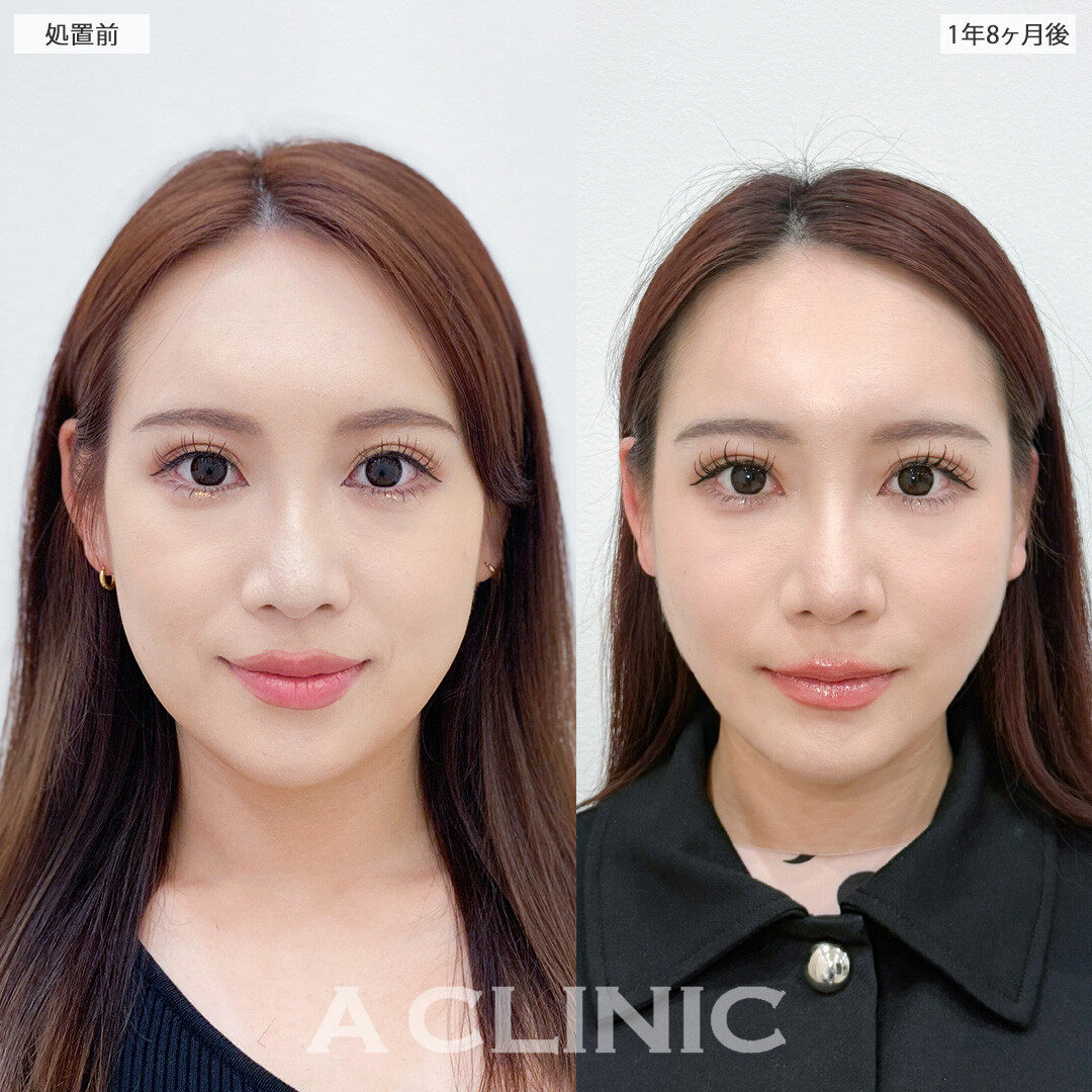 1day小顔脂肪吸引と小顔エラボトックスで1年以上経っても理想のVラインフェイスをキープ！こちら処置前と1年8ヶ月後の症例です(30代女性)