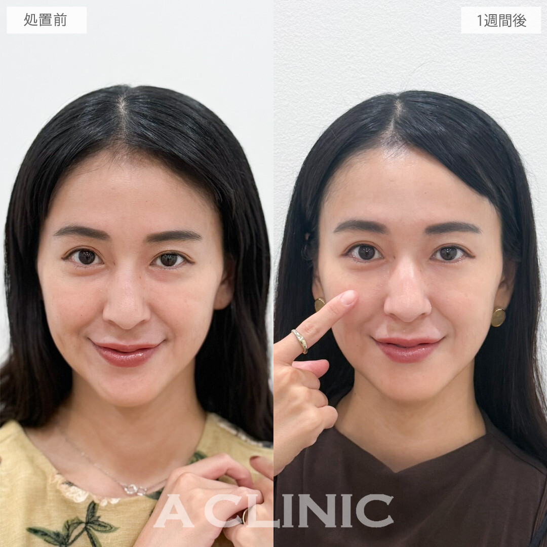 A式コンシーラー注射でメイクでは隠せない目元の凹みがあっという間に目立たなくなりました！処置前と1週間後の症例です(30代女性)