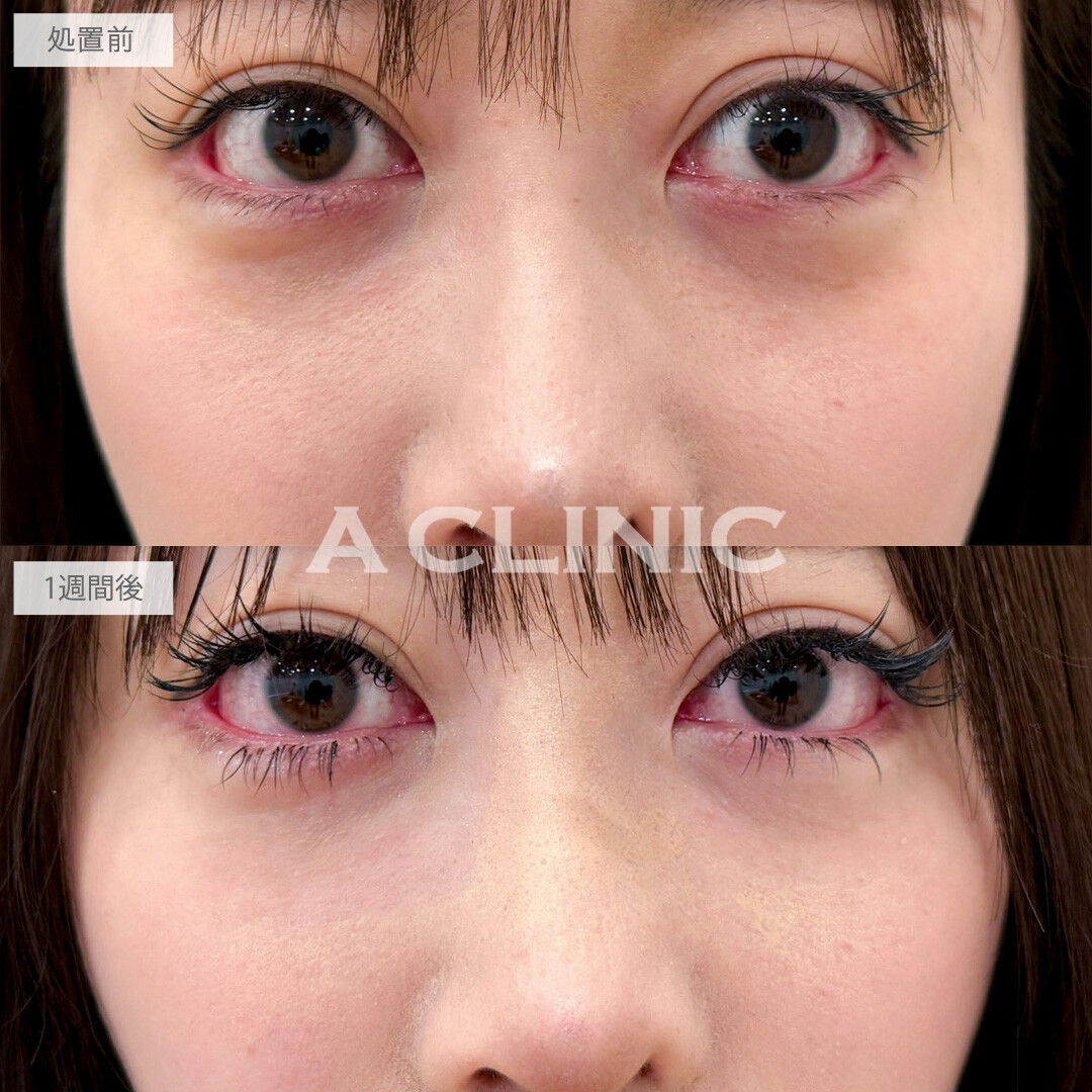 A式コンシーラー注射は目の下の暗い影や窪みを綺麗に補正します！こちら処置前と1週間後の症例です(30代女性)