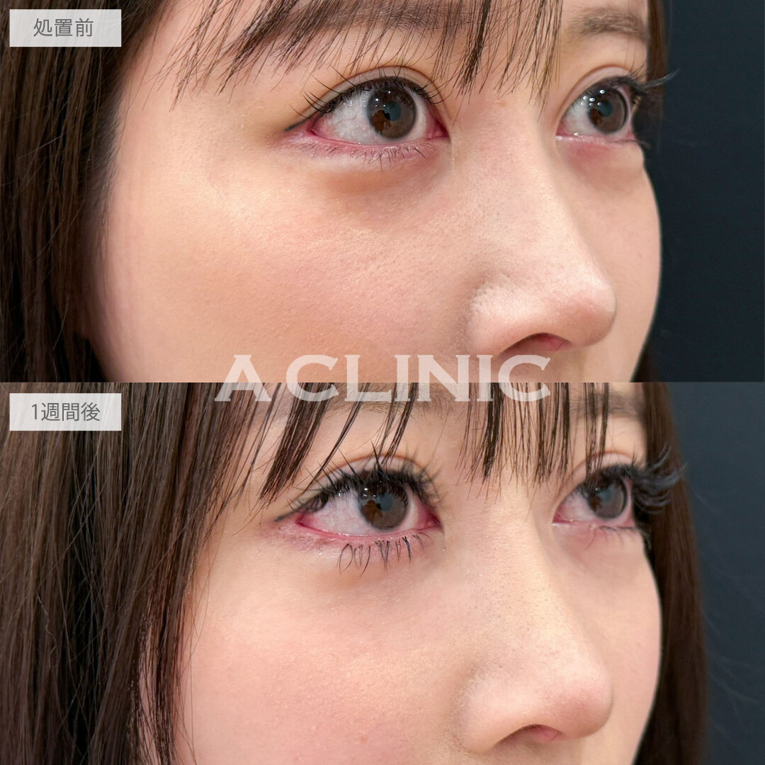 A式コンシーラー注射は目の下の暗い影や窪みを綺麗に補正します！こちら処置前と1週間後の症例です(30代女性)