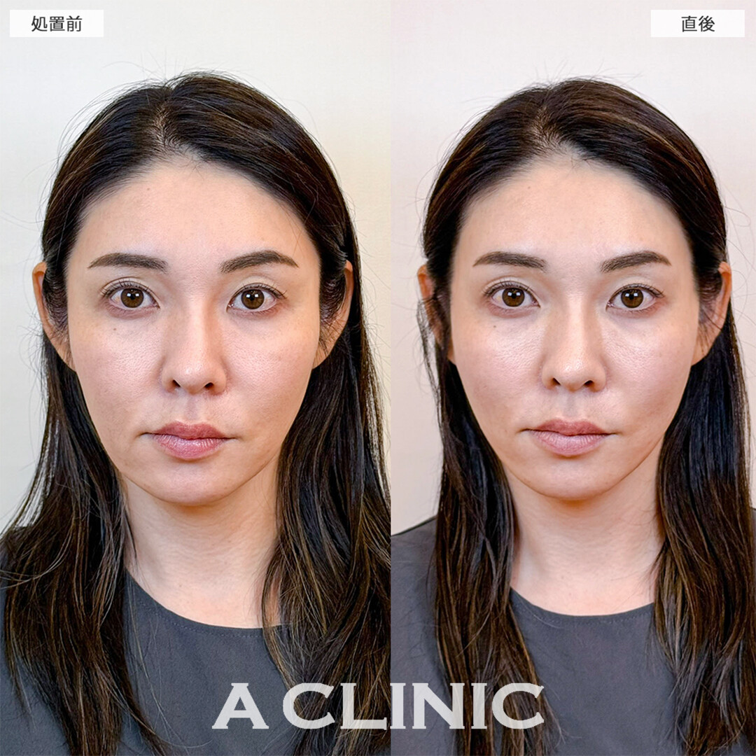 Aスレッドは即効性のある若返り施術です！こちら処置前と直後の症例です(40代女性)