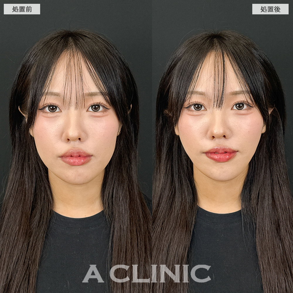 Aスレッドで下膨れがなくなり綺麗なVフェイスになりました！こちら施術前と直後の症例です(20代女性)