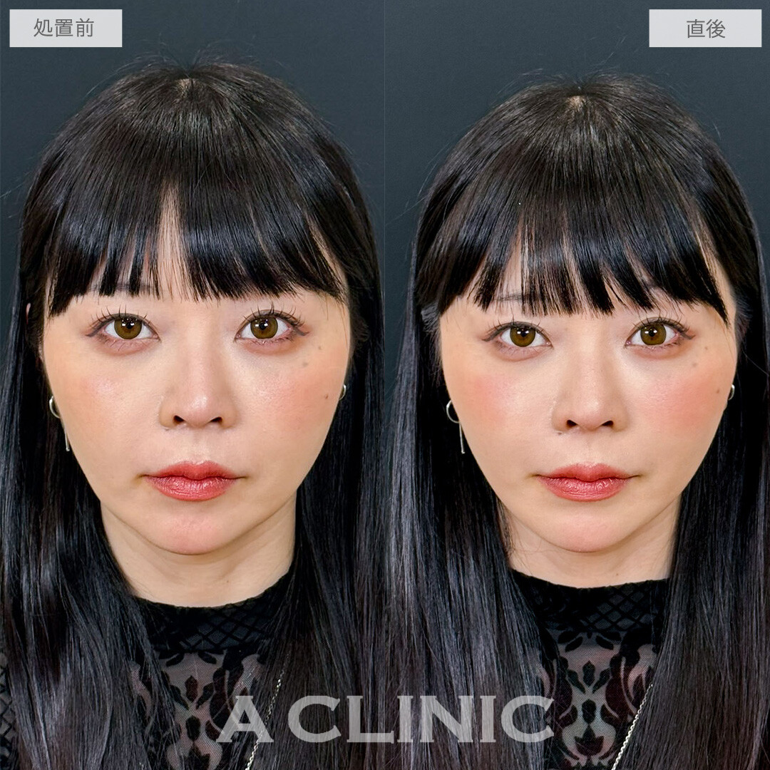 Aスレッドでフェイスラインの重みが減って若返りながら小顔に！こちら処置前と直後の症例です(30代女性)