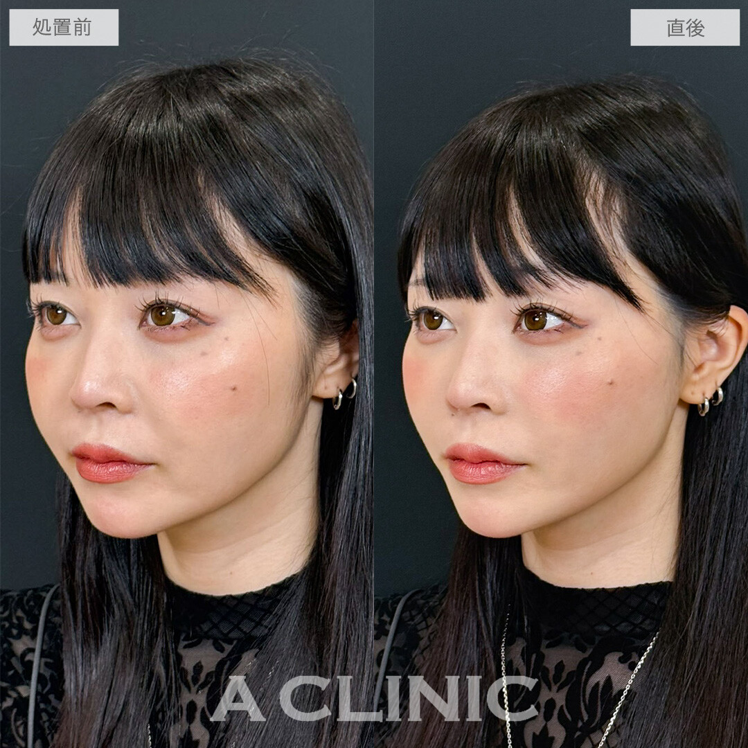 Aスレッドでフェイスラインの重みが減って若返りながら小顔に！こちら処置前と直後の症例です(30代女性)