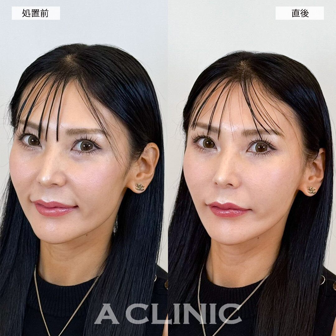 Aスレッドで痩せてたるみが気になってきた輪郭をしっかりリフトアップ！こちら処置前と直後の症例です(30代女性)