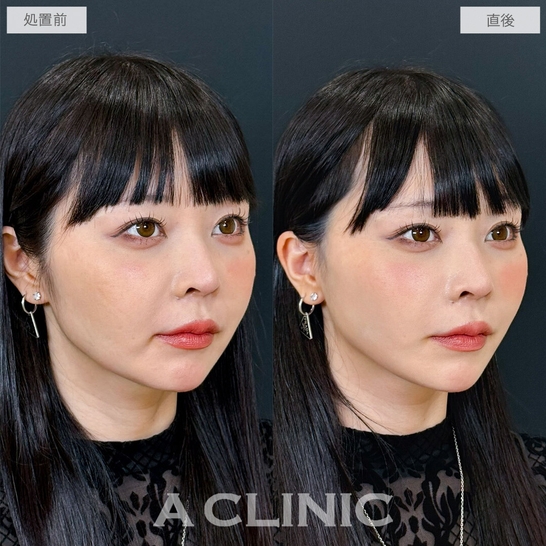 Aスレッドでフェイスラインの重みが減って若返りながら小顔に！こちら処置前と直後の症例です(30代女性)