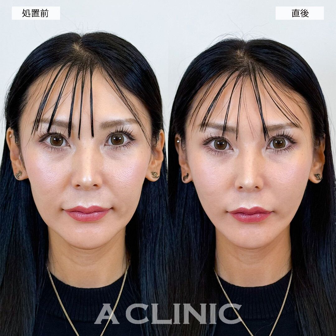Aスレッドで痩せてたるみが気になってきた輪郭をしっかりリフトアップ！こちら処置前と直後の症例です(30代女性)