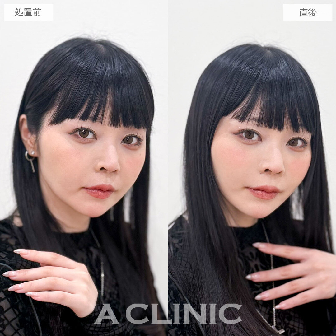 Aスレッドでフェイスラインの重みが減って若返りながら小顔に！こちら処置前と直後の症例です(30代女性)