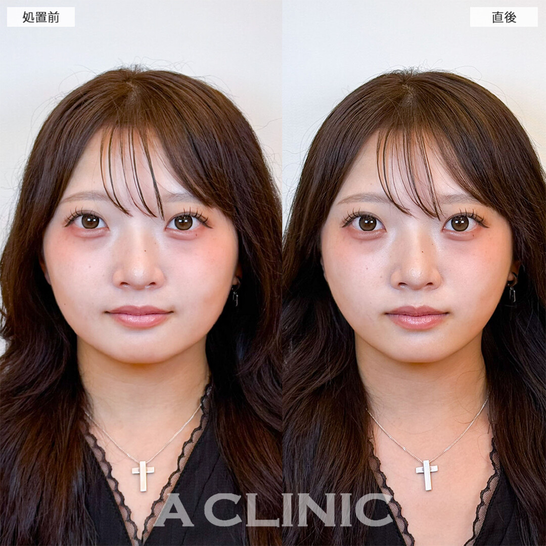 Aスレッドで綺麗なVフェイスになれました！こちら処置前と直後の症例です(20代女性)