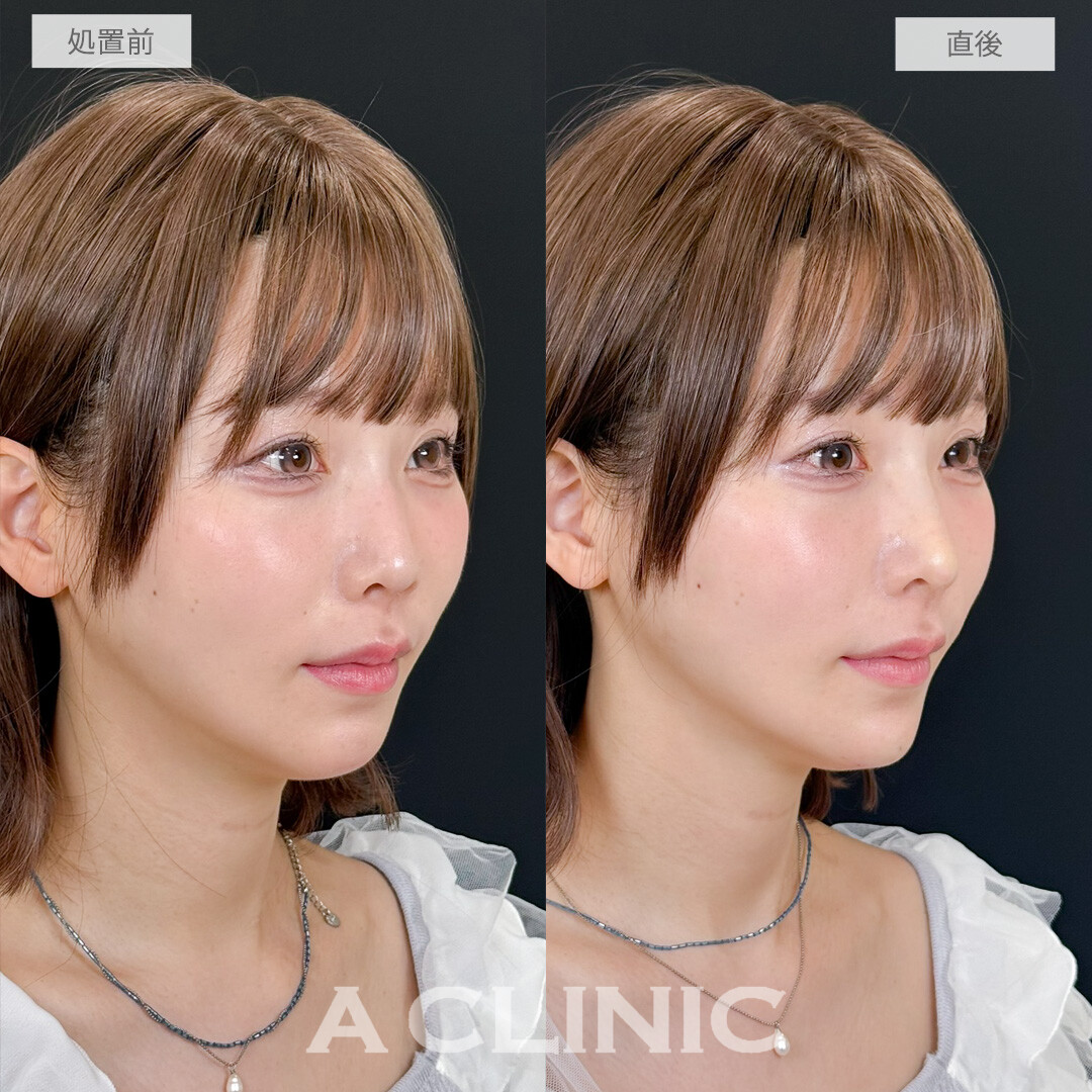 ヒアルロン酸カスタマイズメニューで全方位で美人度アップ！処置前と直後の症例です(30代女性)