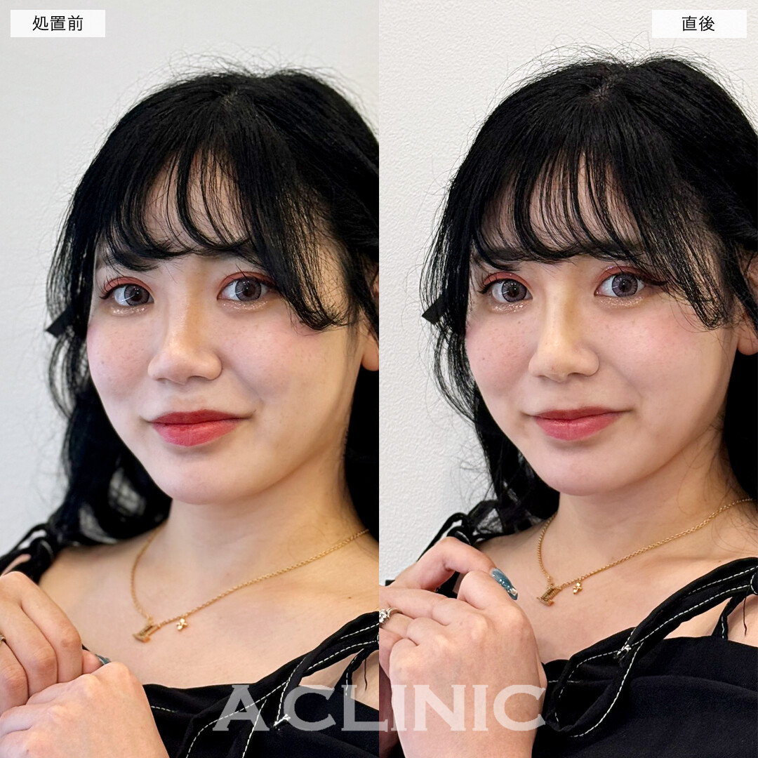 ジャスミンノーズで横顔が今っぽく垢抜けました！処置前と直後の症例です(30代女性)