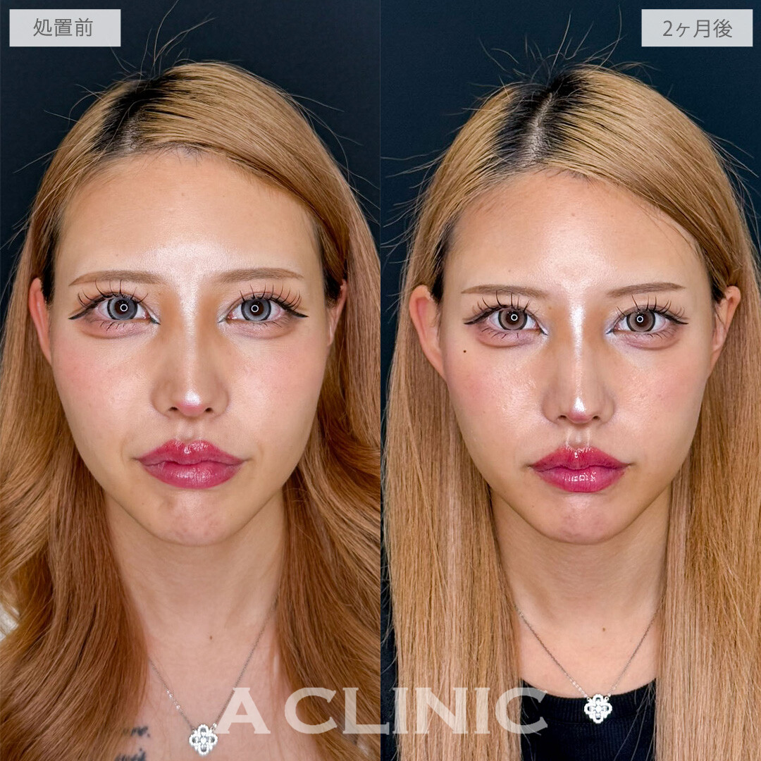A式ナゾラリフトでほうれい線周りの重みを解消し若々しい印象に！こちら処置前と2か月後の症例です(20代女性)