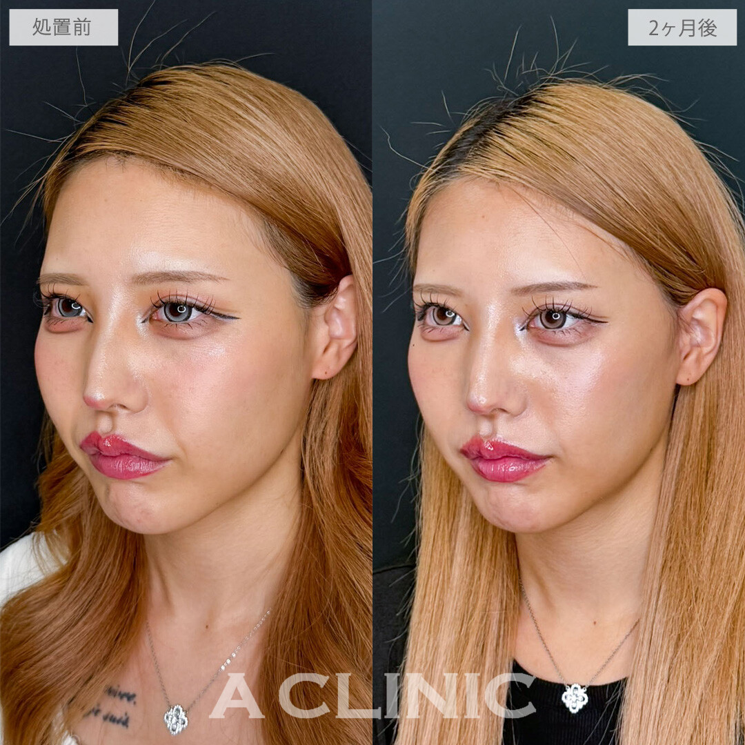 A式ナゾラリフトでほうれい線周りの重みを解消し若々しい印象に！こちら処置前と2か月後の症例です(20代女性)