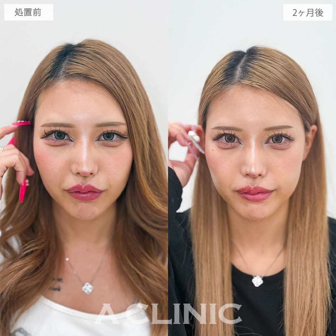 A式ナゾラリフトでほうれい線周りの重みを解消し若々しい印象に！こちら処置前と2か月後の症例です(20代女性)