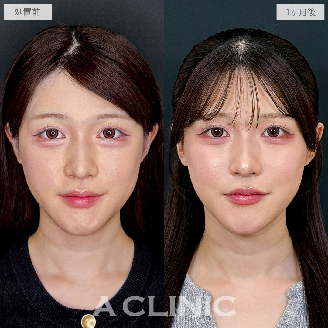 1day小顔脂肪吸引でエラ下をすっきりさせて無駄のない美輪郭に！こちら処置前から1か月後の症例です(20代女性)
