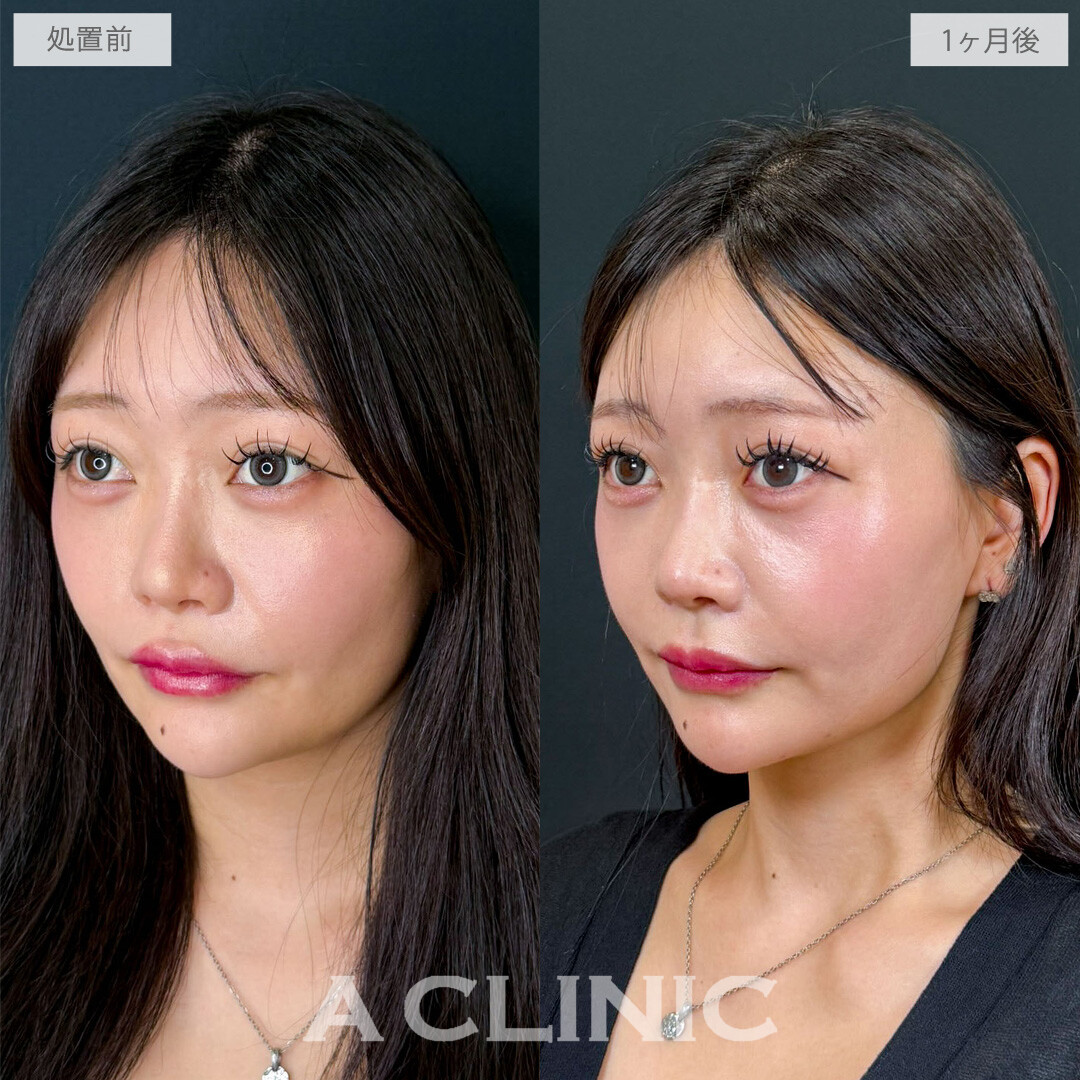 1day小顔脂肪吸引でもたつきがなくなり余白ゼロ顔に！こちら処置前と1か月後の症例です(20代女性)