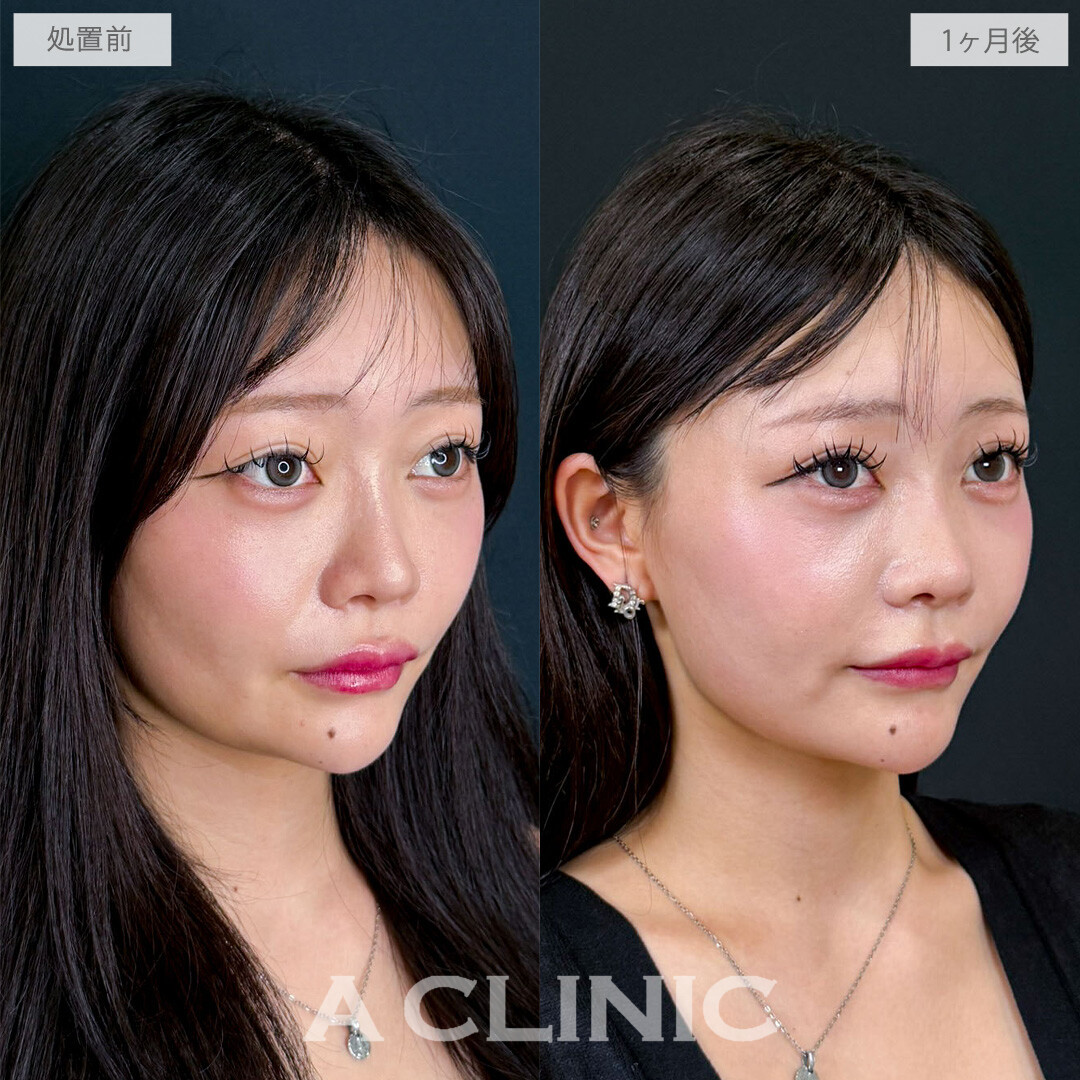 1day小顔脂肪吸引でもたつきがなくなり余白ゼロ顔に！こちら処置前と1か月後の症例です(20代女性)
