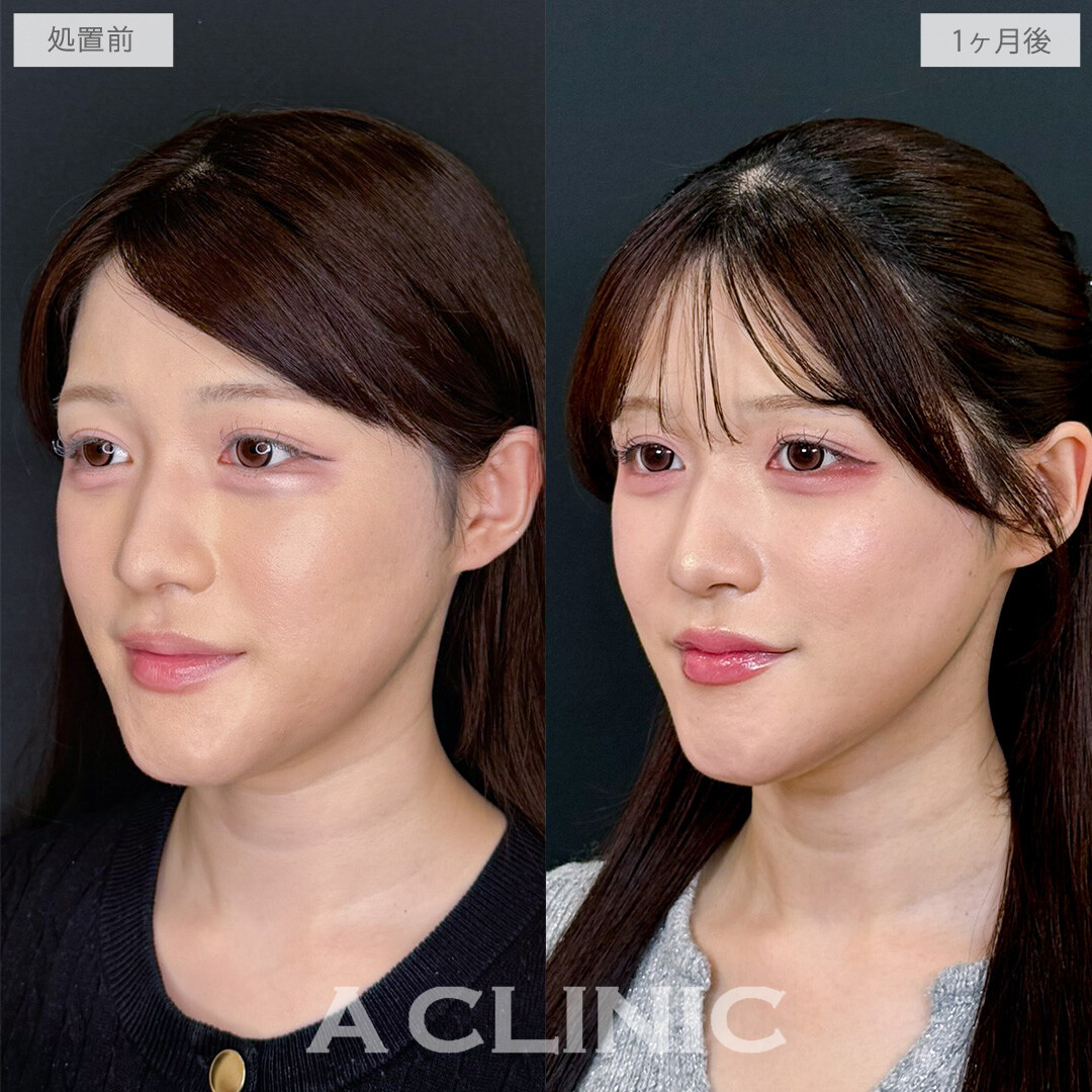 1day小顔脂肪吸引でエラ下をすっきりさせて無駄のない美輪郭に！こちら処置前から1か月後の症例です(20代女性)