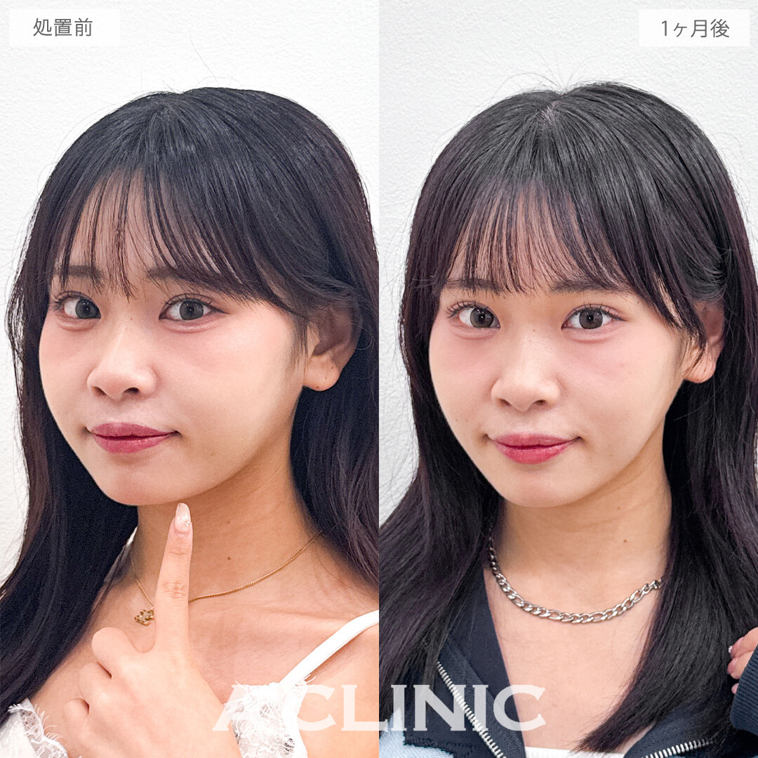 1day小顔脂肪吸引で埋もれていたフェイスラインを綺麗に出すことができます！こちら処置前と1か月後の症例です(20代女性)