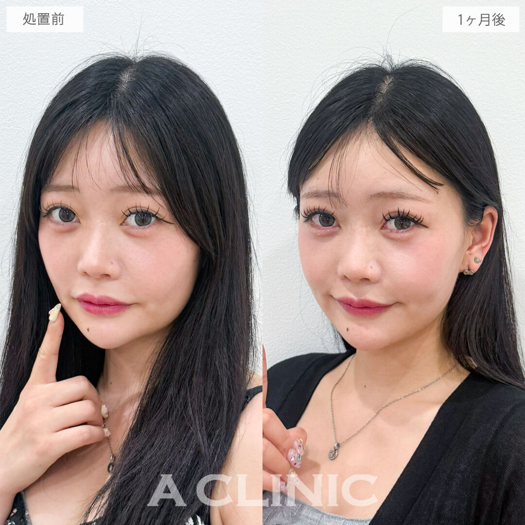 1day小顔脂肪吸引でもたつきがなくなり余白ゼロ顔に！こちら処置前と1か月後の症例です(20代女性)