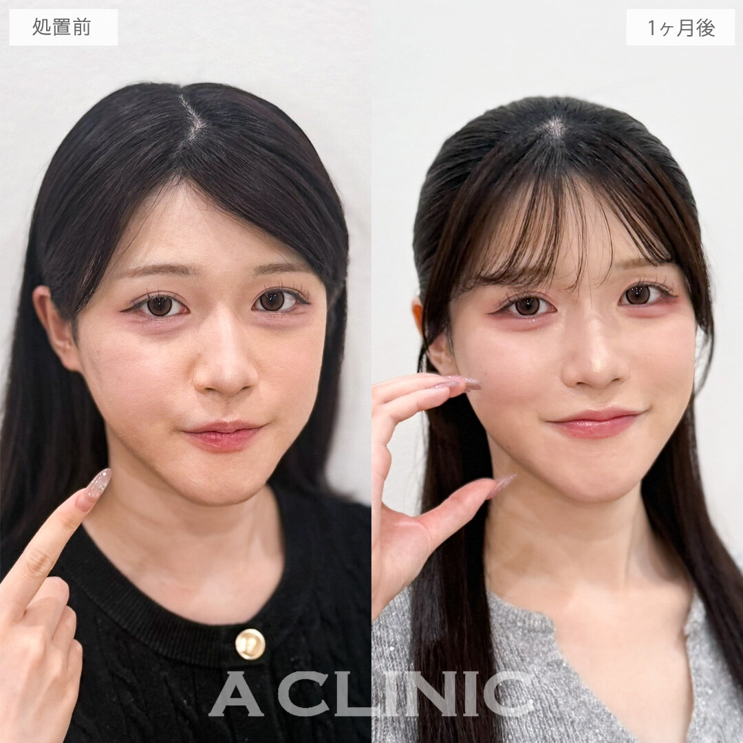 1day小顔脂肪吸引でエラ下をすっきりさせて無駄のない美輪郭に！こちら処置前から1か月後の症例です(20代女性)