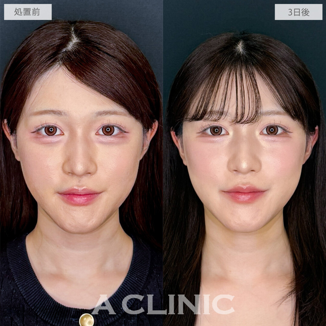 1day小顔脂肪吸引でエラ下をすっきりさせて無駄のない美輪郭に！こちら処置前から1か月後の症例です(20代女性)