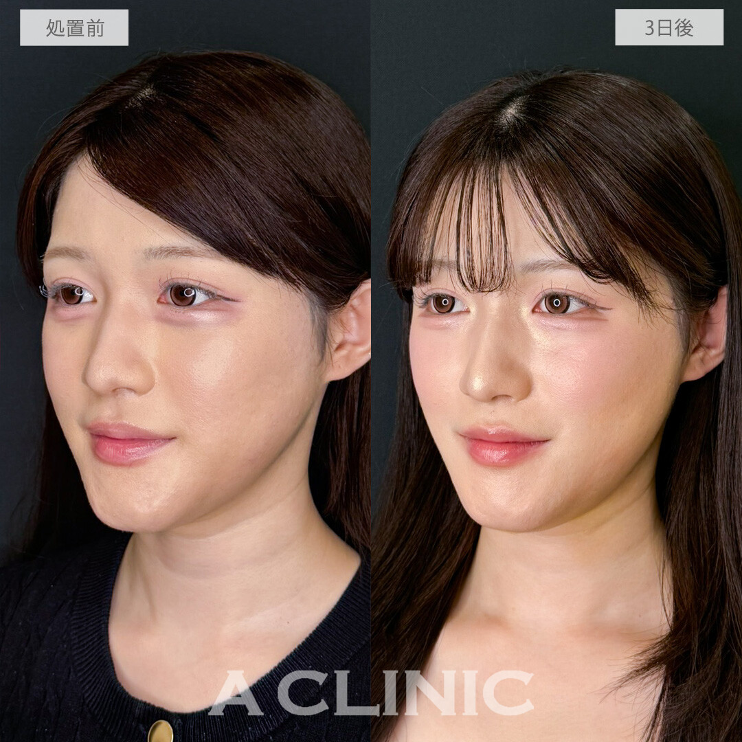1day小顔脂肪吸引でエラ下をすっきりさせて無駄のない美輪郭に！こちら処置前から1か月後の症例です(20代女性)