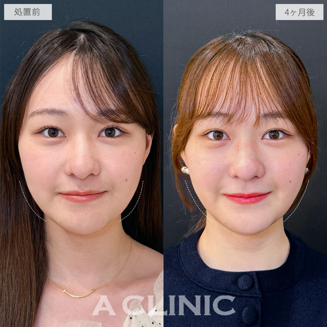 1day小顔脂肪吸引でお顔のぽにょ肉をオフできました！こちら処置前と4か月後の症例です(20代女性)