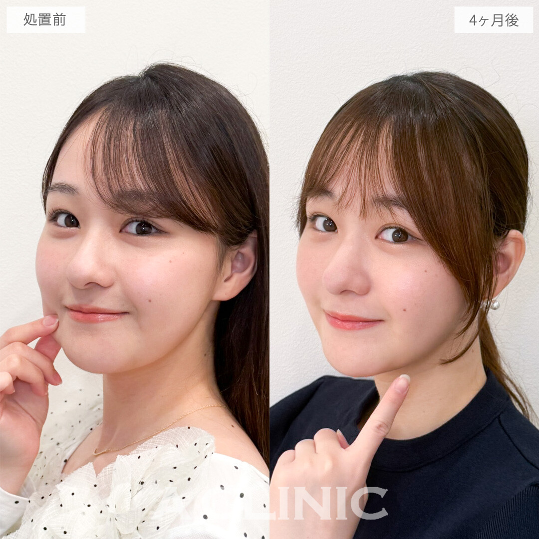 1day小顔脂肪吸引でお顔のぽにょ肉をオフできました！こちら処置前と4か月後の症例です(20代女性)