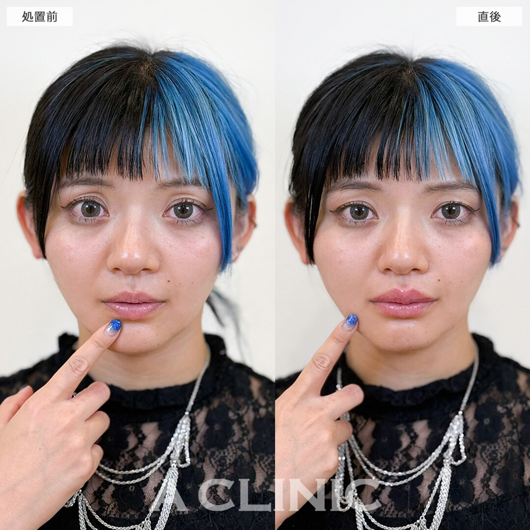 スマイルリップでふっくら唇と人中短縮効果！処置前と直後の症例です(30代女性)