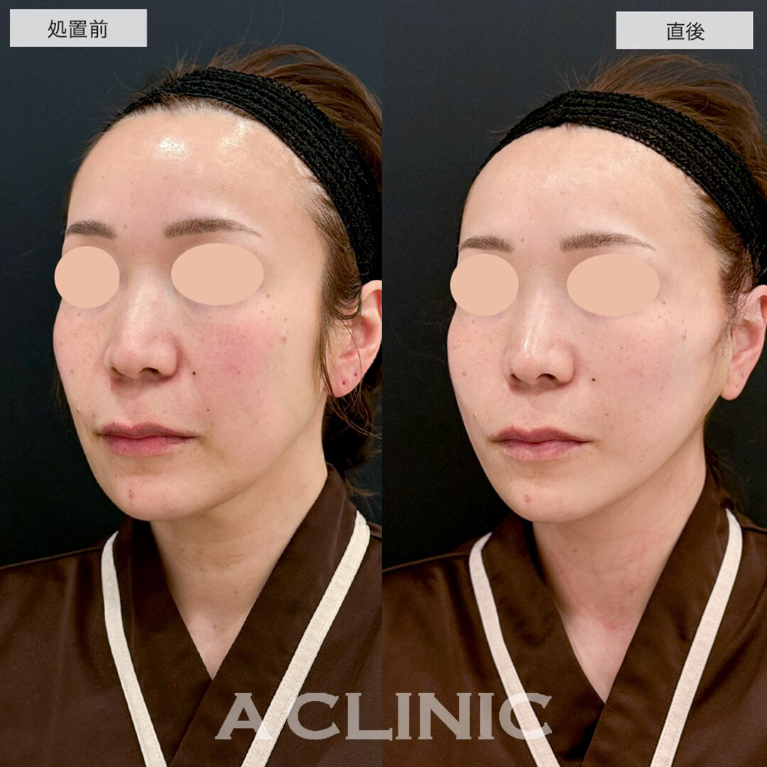 A式たるみ切開は抜糸不要かつ腫れ最初限でたるみを根本的に改善します! こちら処置前と直後の症例です(30代女性)