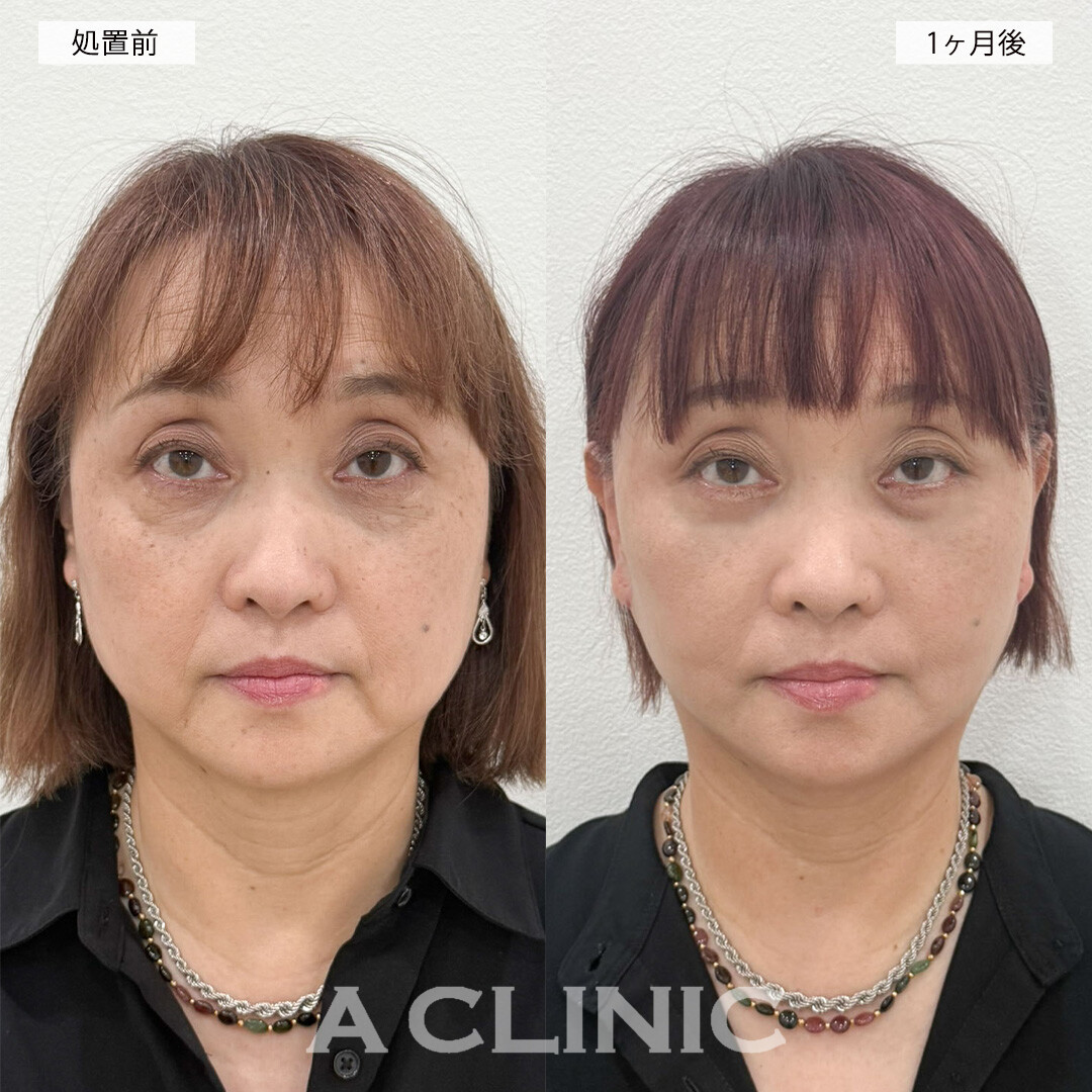 複合施術で長年のお悩みだったお顔のたるみや疲れ目が解消され若返り成功！こちら処置前と1ヶ月後の症例です(60代女性)