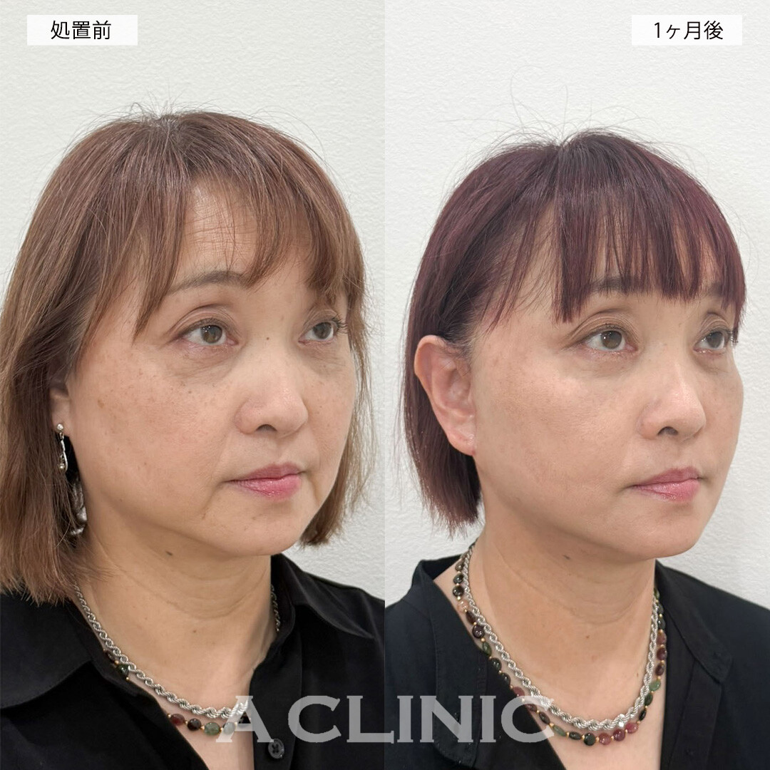 複合施術で長年のお悩みだったお顔のたるみや疲れ目が解消され若返り成功！こちら処置前と1ヶ月後の症例です(60代女性)