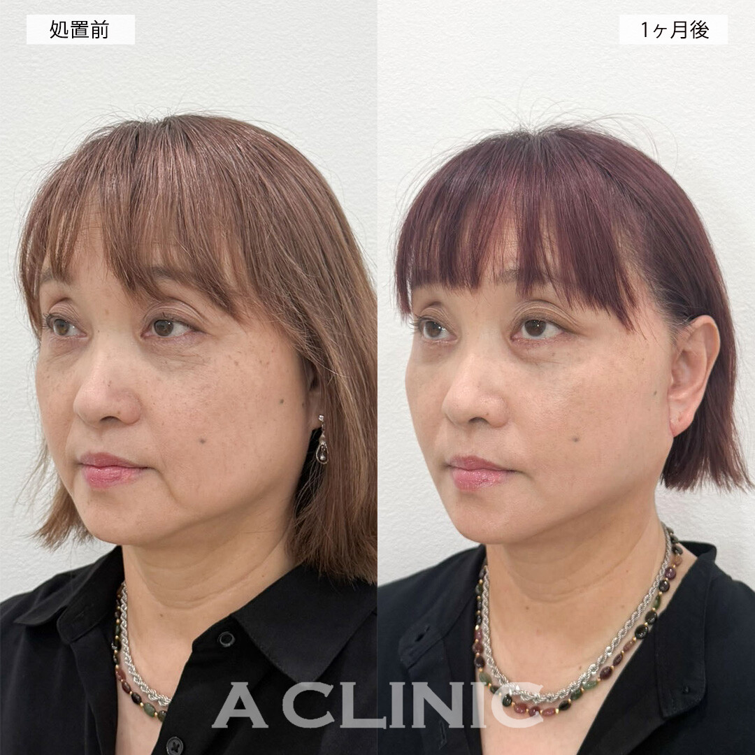 複合施術で長年のお悩みだったお顔のたるみや疲れ目が解消され若返り成功！こちら処置前と1ヶ月後の症例です(60代女性)