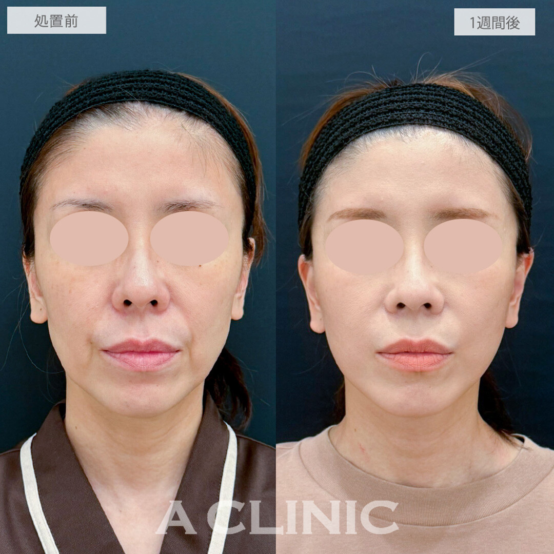 A式たるみ切開とヒアルロン酸注射(シワ)でほうれい線が薄くなり若返り成功！処置前と1週間後の症例です(40代女性)