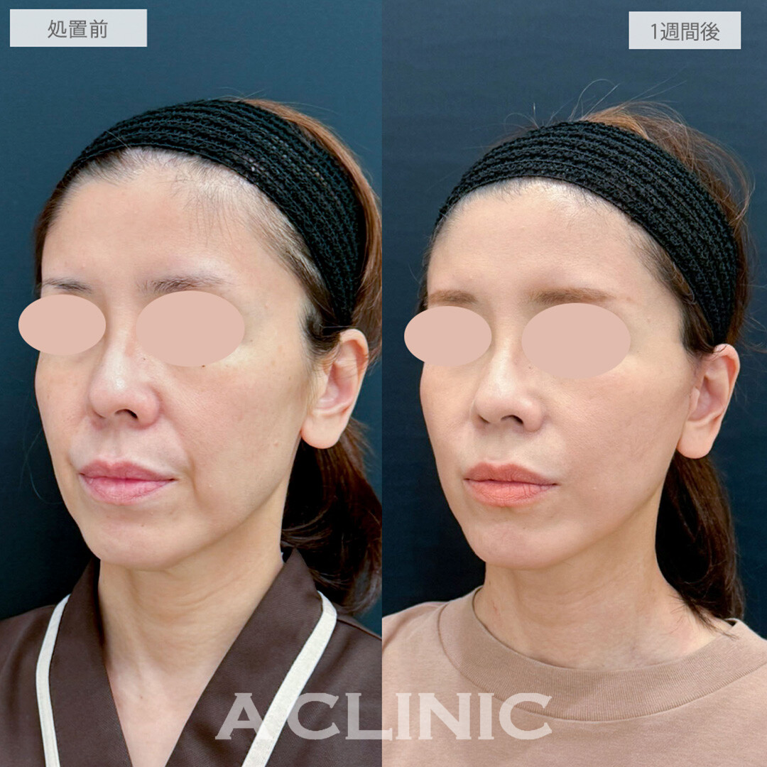 A式たるみ切開とヒアルロン酸注射(シワ)でほうれい線が薄くなり若返り成功！処置前と1週間後の症例です(40代女性)