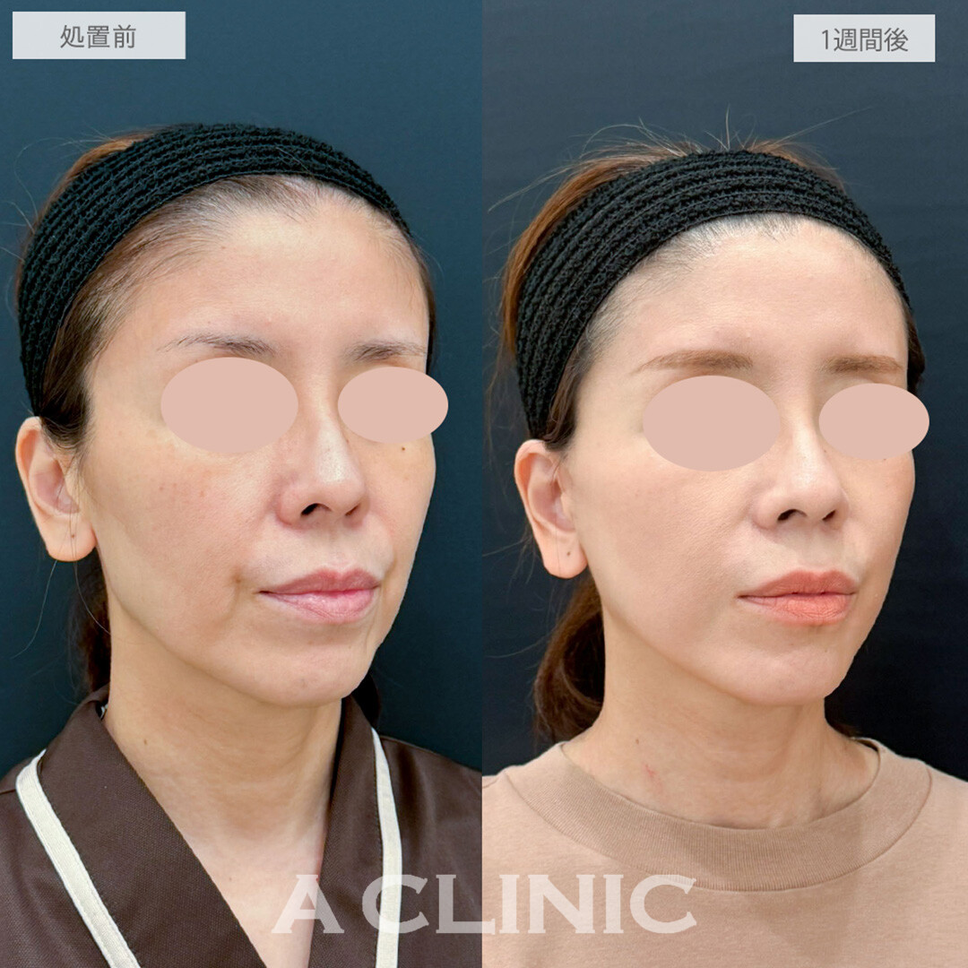 A式たるみ切開とヒアルロン酸注射(シワ)でほうれい線が薄くなり若返り成功！処置前と1週間後の症例です(40代女性)