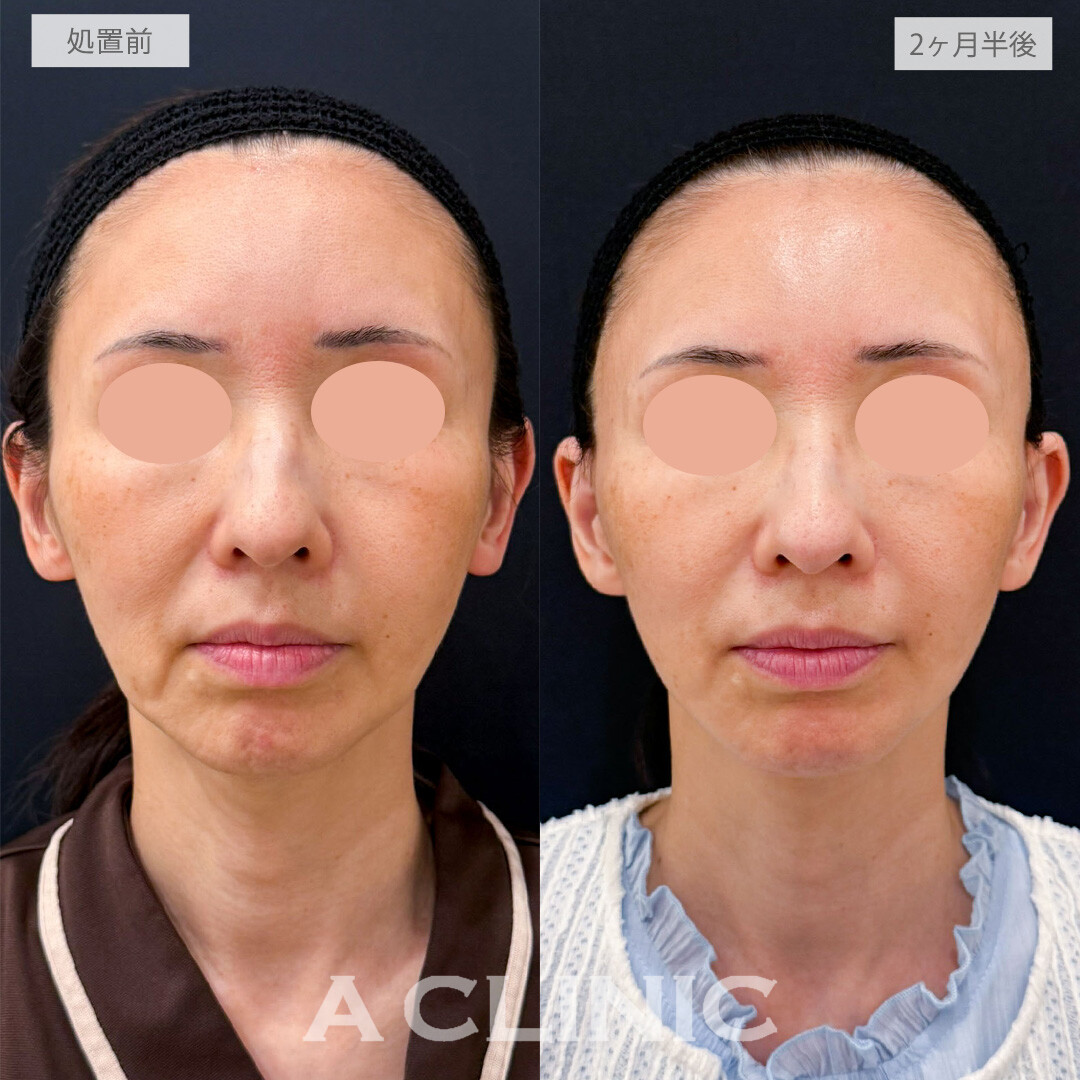 【直後の傷跡あり】A式たるみ切開でいつまでも若々しい上質なフェイスラインへ整えました！こちら処置前と2ヶ月半後の症例です(50代女性)