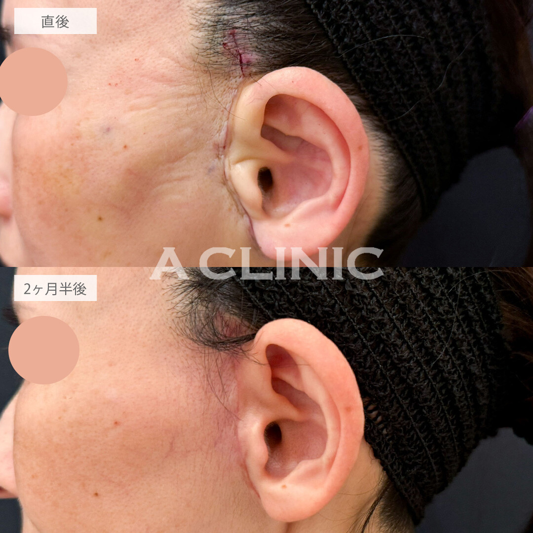 【直後の傷跡あり】A式たるみ切開でいつまでも若々しい上質なフェイスラインへ整えました！こちら処置前と2ヶ月半後の症例です(50代女性)