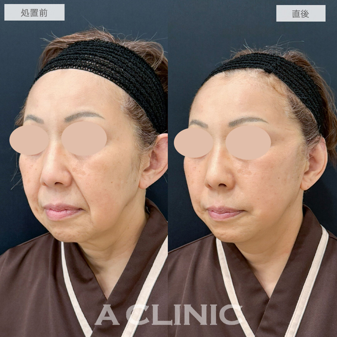 A式たるみ切開でほうれい線が改善され脱ブルドッグ！処置前と直後の症例です(60代女性)
