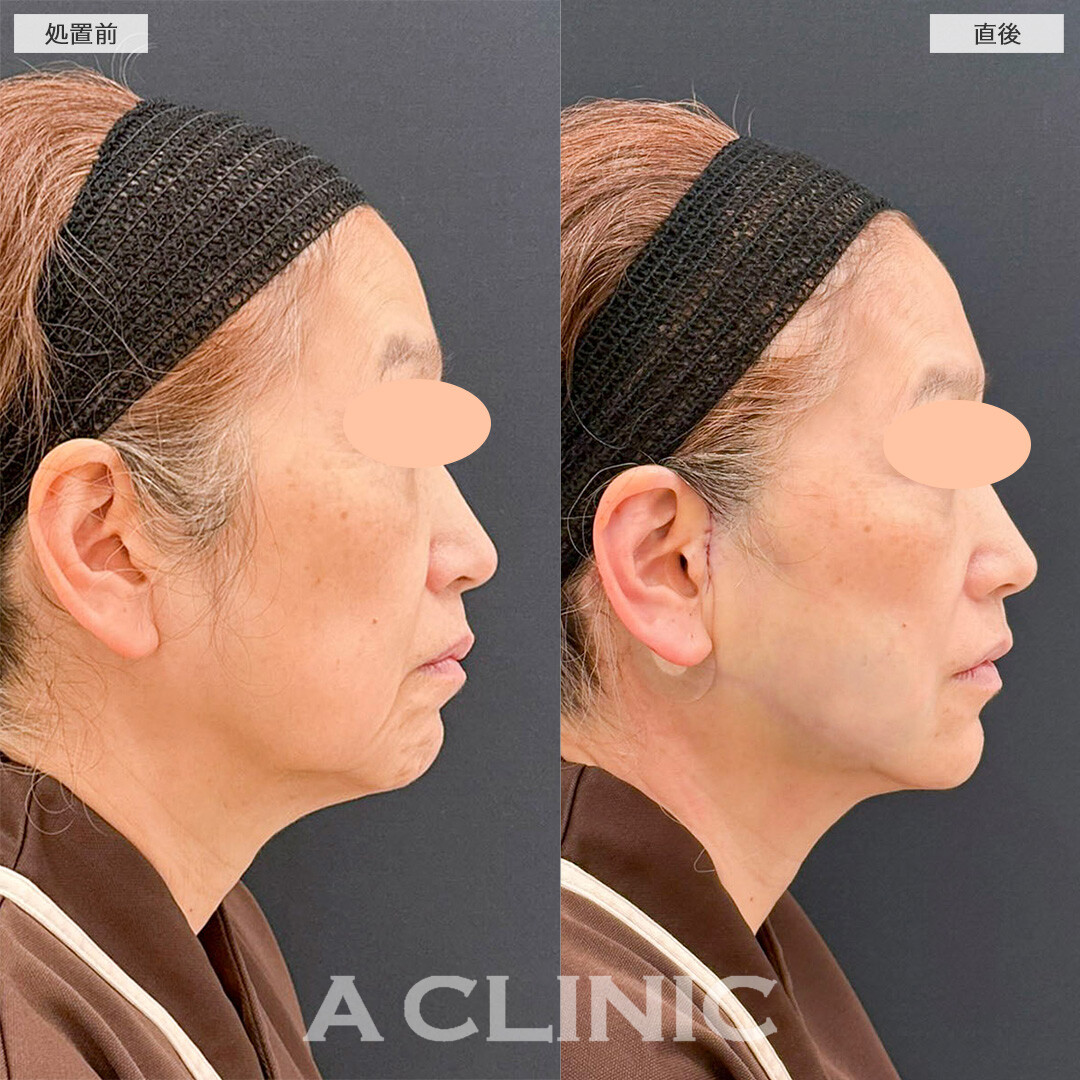 【直後の傷跡あり】A式たるみ切開と1day小顔脂肪吸引で直後から口元の印象が激変！処置前と直後の症例です(60代女性)