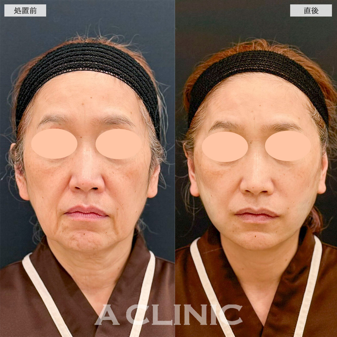 【直後の傷跡あり】A式たるみ切開と1day小顔脂肪吸引で直後から口元の印象が激変！処置前と直後の症例です(60代女性)
