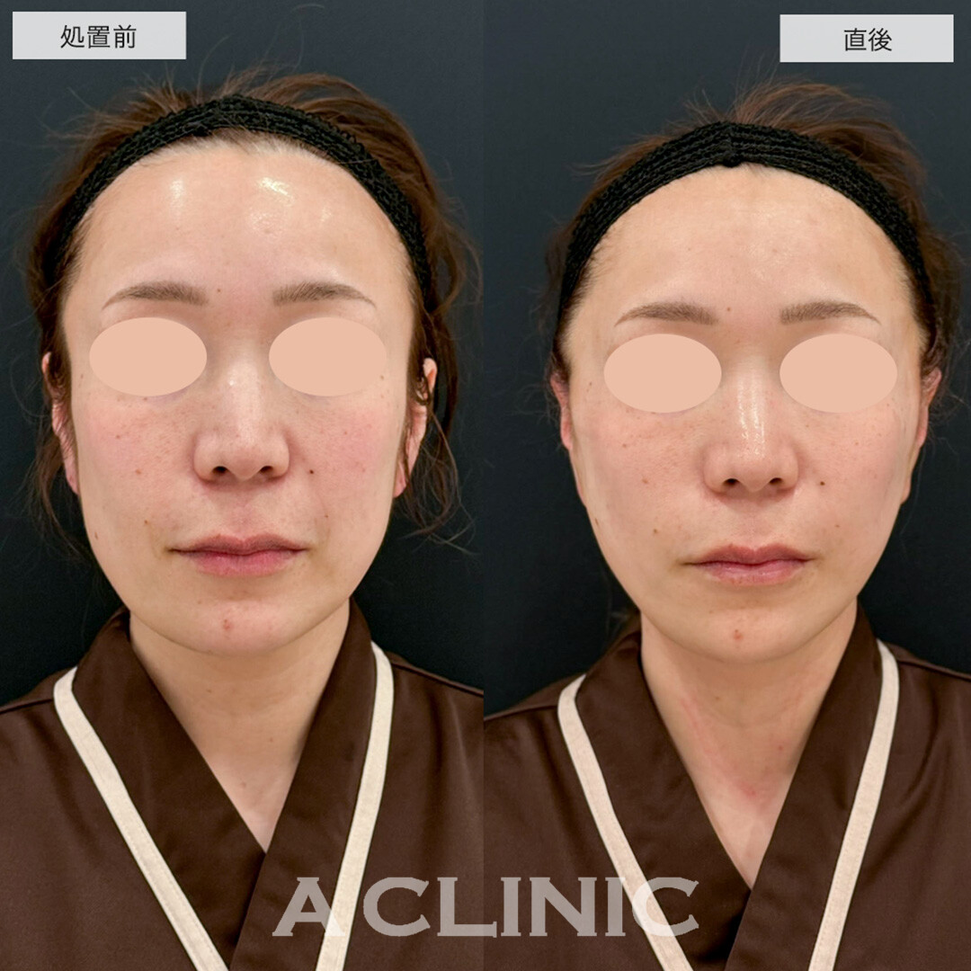 A式たるみ切開は抜糸不要かつ腫れ最初限でたるみを根本的に改善します! こちら処置前と直後の症例です(30代女性)