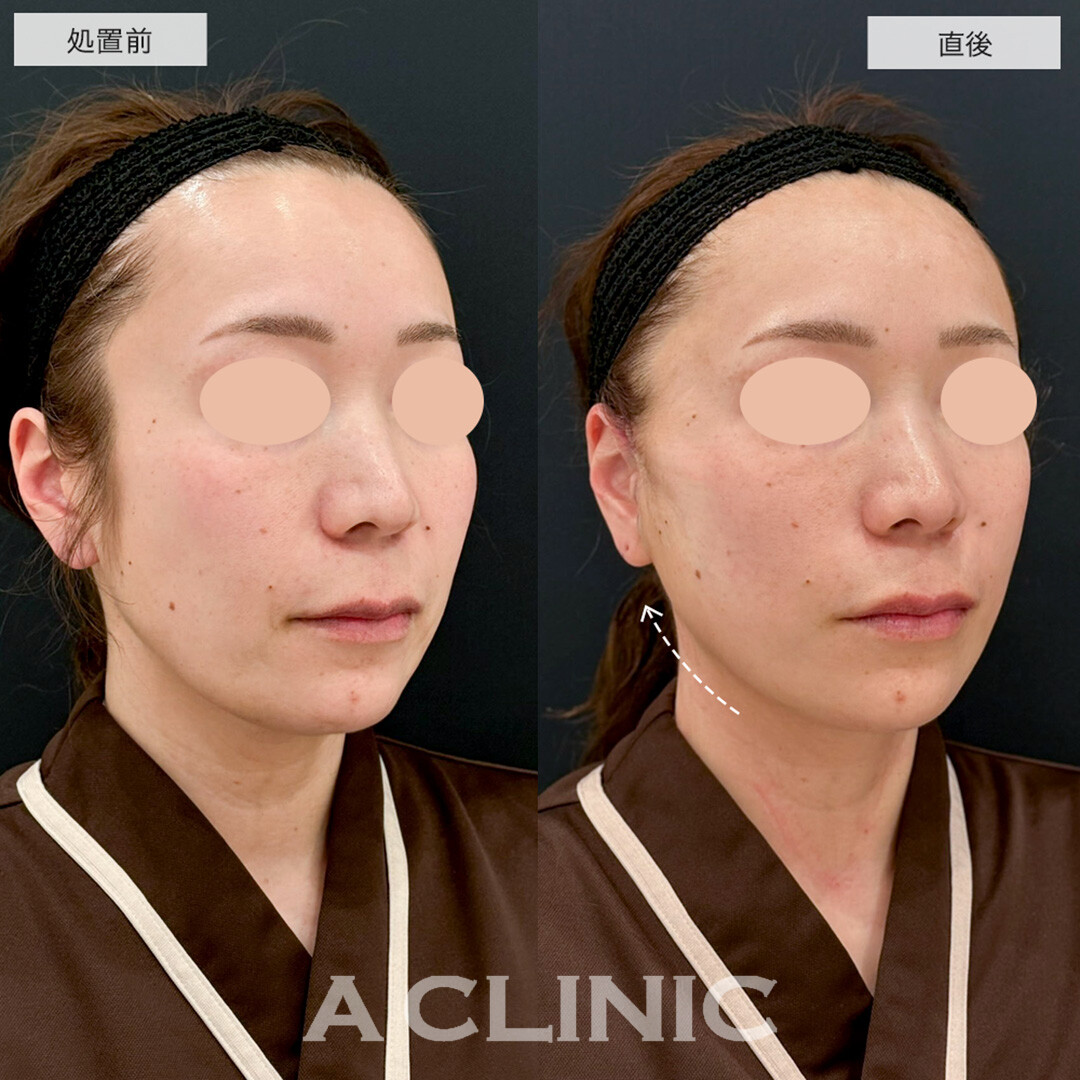 A式たるみ切開は抜糸不要かつ腫れ最初限でたるみを根本的に改善します! こちら処置前と直後の症例です(30代女性)