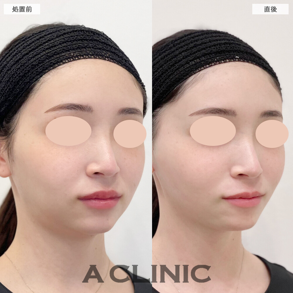 A式トリニティリフトでフェイスラインがナチュラルに整いました！こちら処置前と直後の症例です(20代女性)