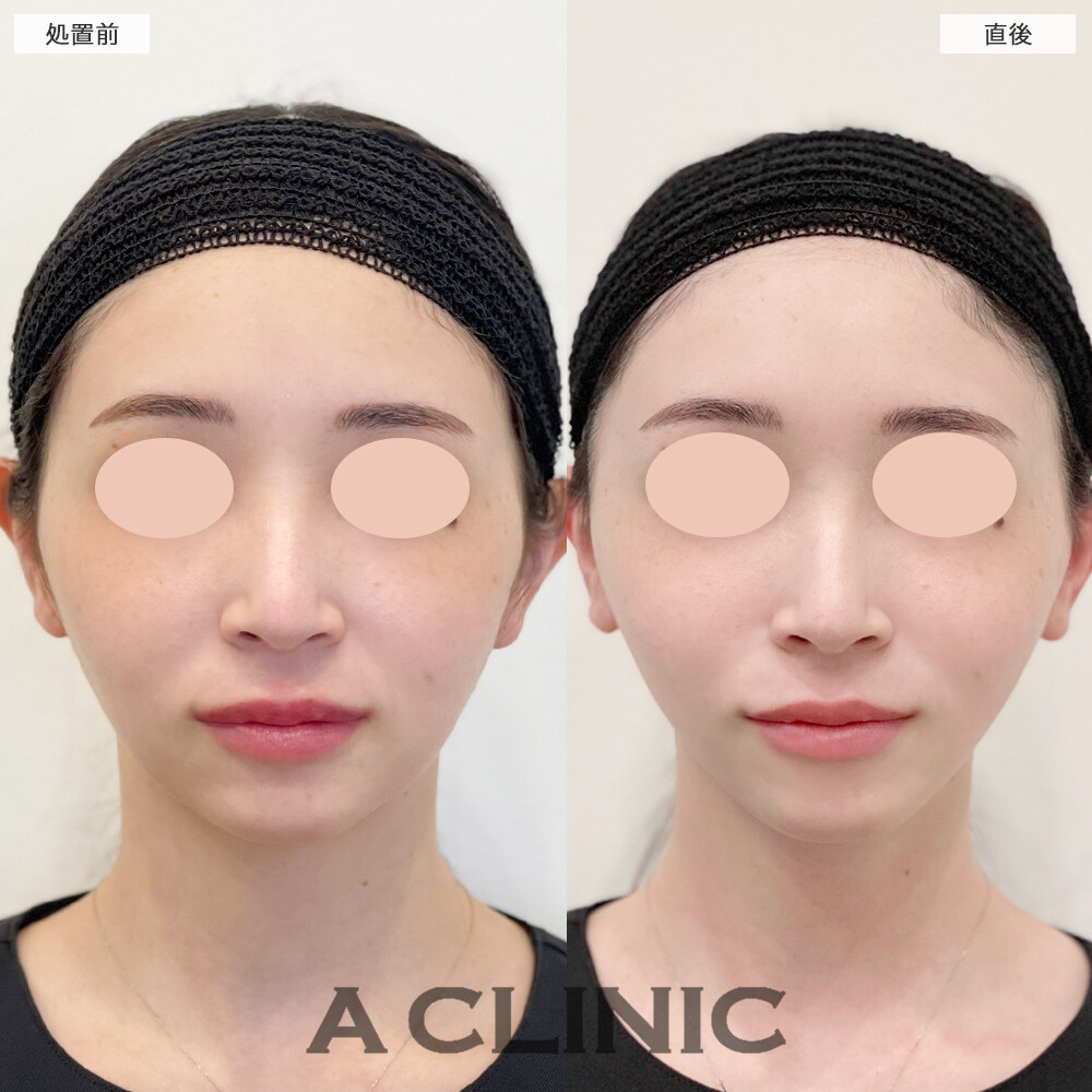 A式トリニティリフトでフェイスラインがナチュラルに整いました！こちら処置前と直後の症例です(20代女性)